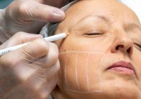 Simcoe Cosmetic - Med Spa & Tattoo Removal Clinic in Barrie & Ontario.