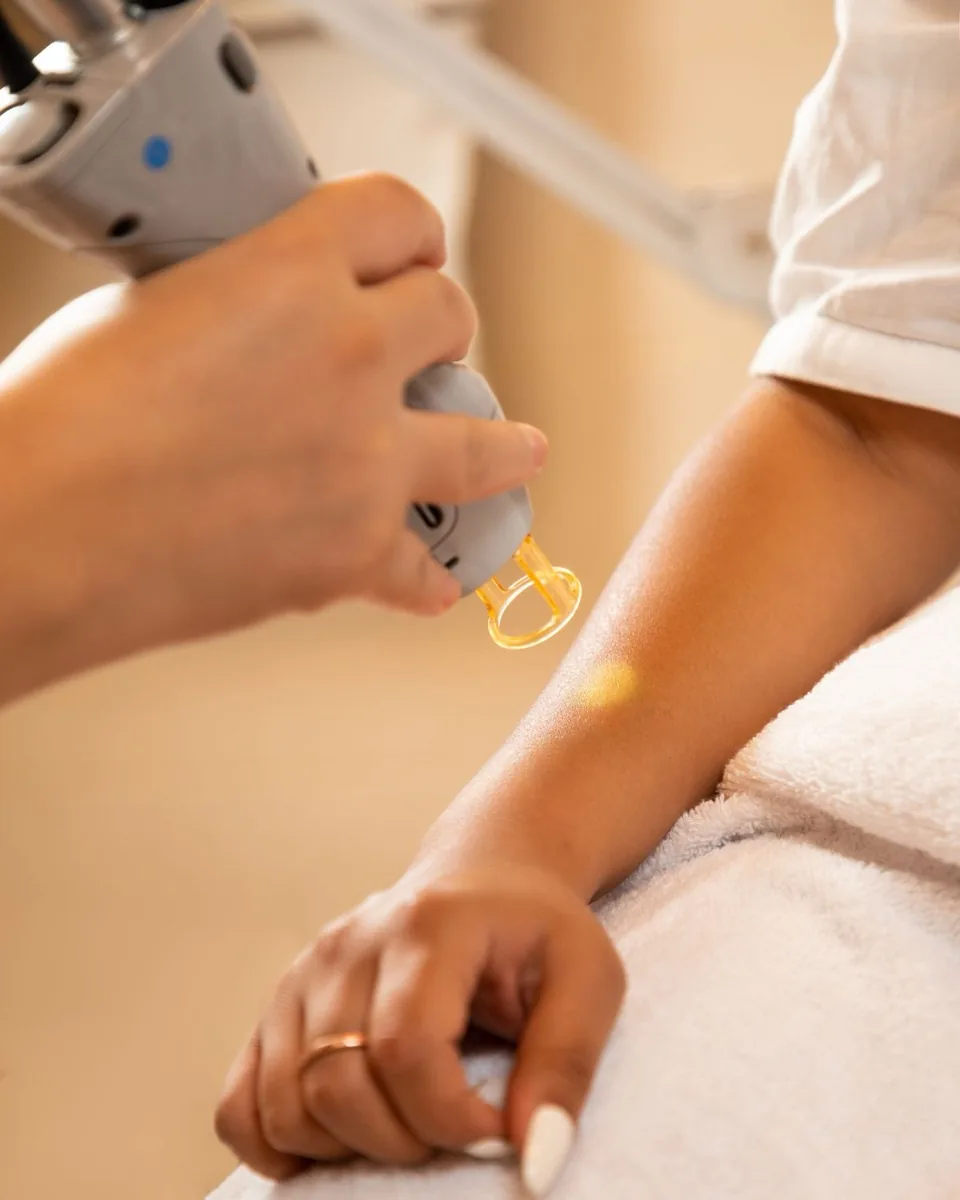Laser hair removal treatment on an arm, illustrating Laser Hair Removal in Barrie at Simcoe Cosmetic Clinic