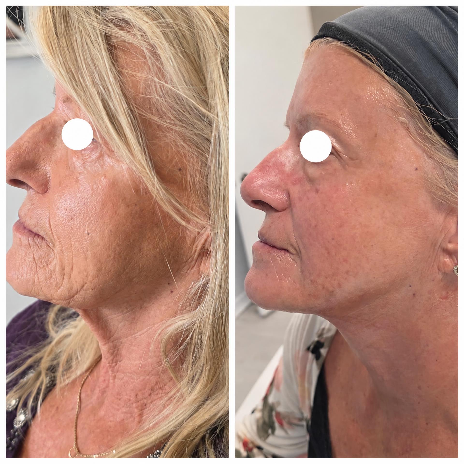 Before and after side profile, client's eyes covered for privacy: tighter skin along the jaw and smoother cheek texture