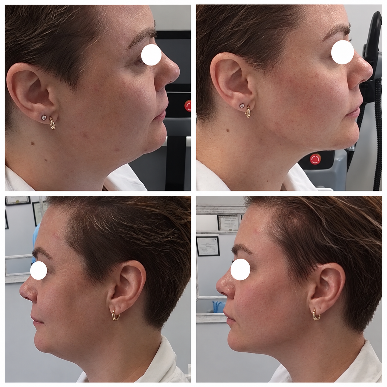 Before and after PDO thread lift: firmer jawline and neck, both profiles, client's eyes covered for privacy