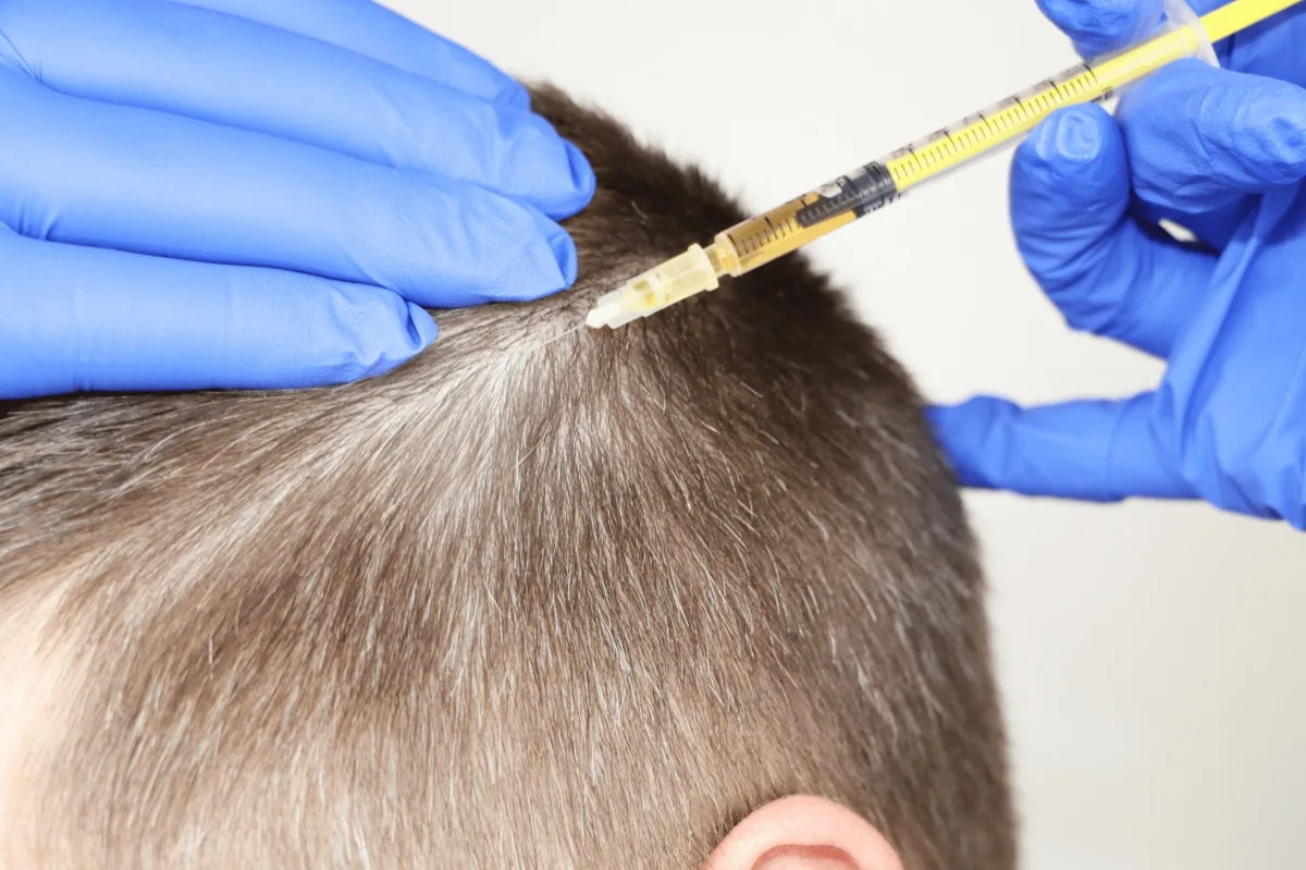 PRP scalp injection treatment, illustrating PRP Hair Restoration in Barrie at Simcoe Cosmetic Clinic