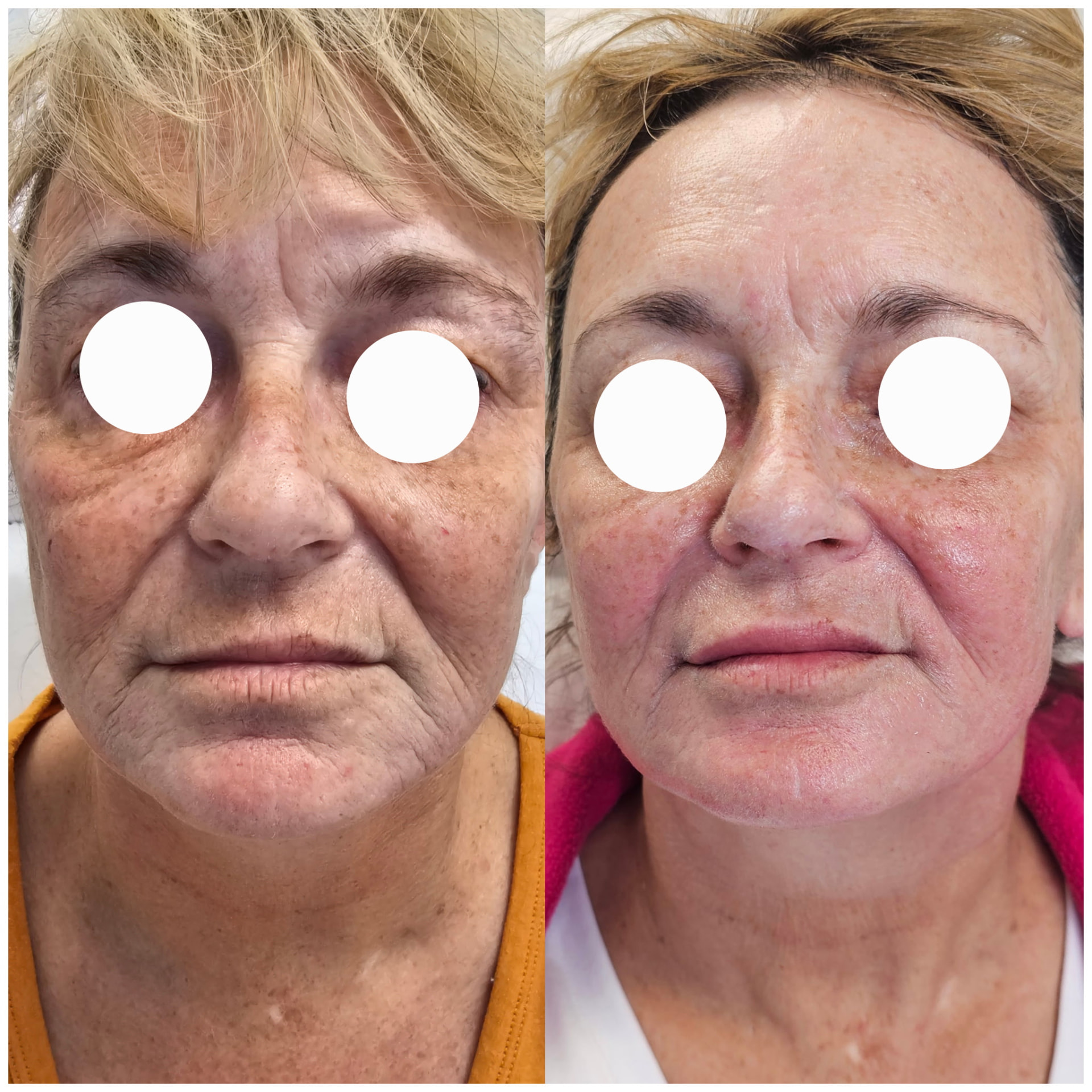 Before and after facial skin treatment: smoother texture and fewer sun spots, client's eyes covered for privacy