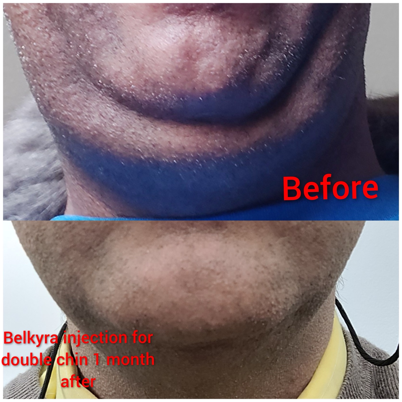 Belkyra double chin treatment before and one month after at Simcoe Cosmetic Clinic