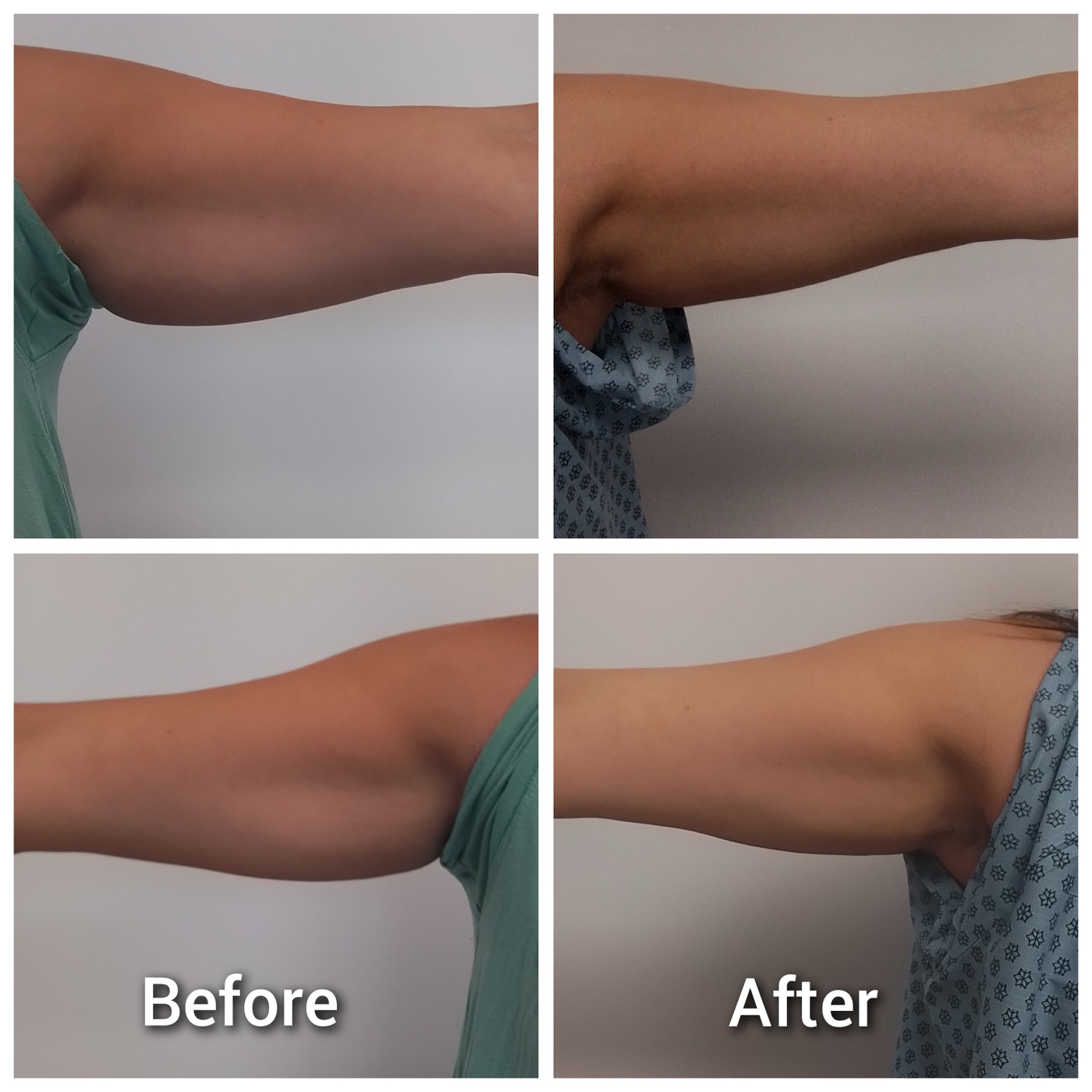 Fat dissolving injection arm results before and after at Simcoe Cosmetic Clinic