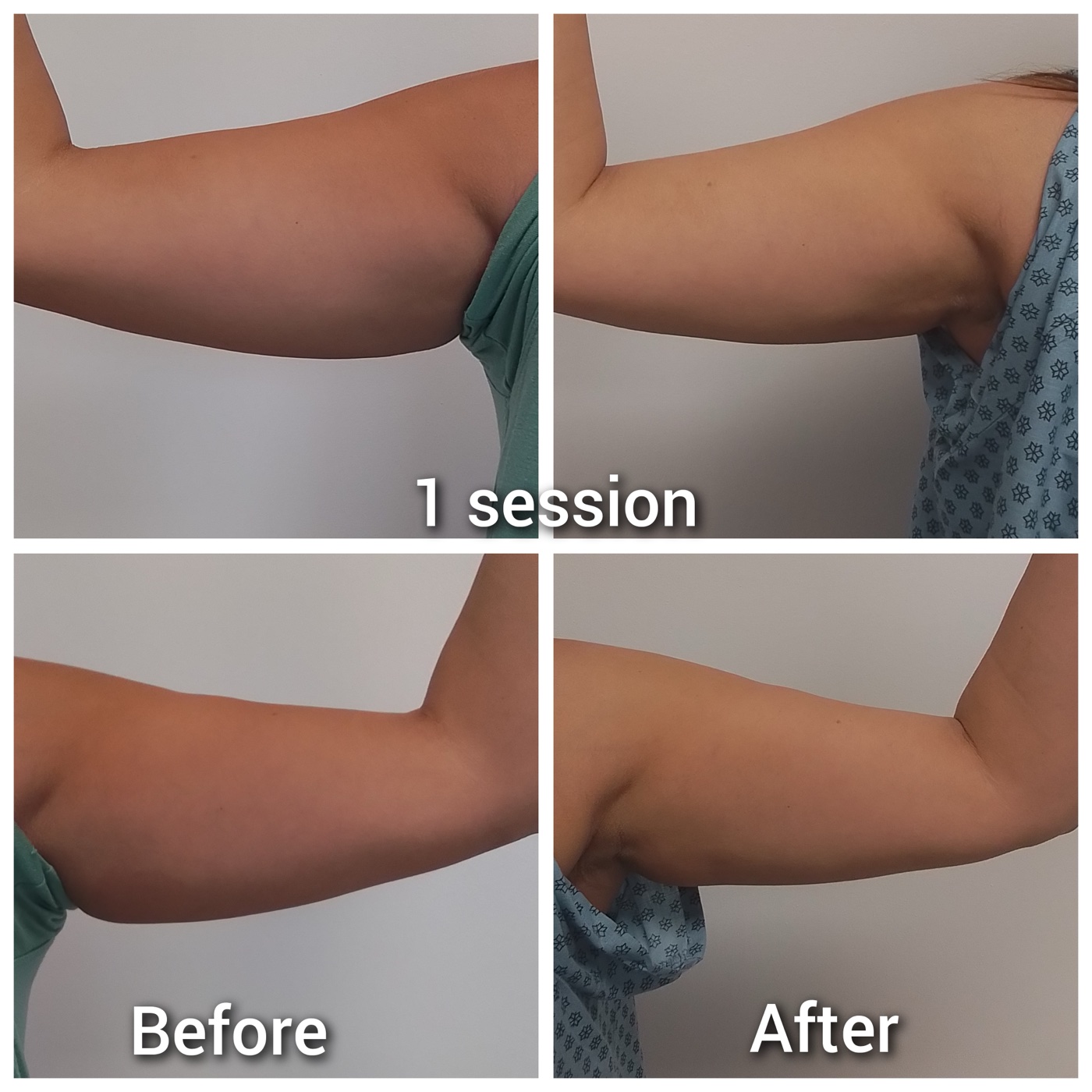 Fat dissolving injection results after one session at Simcoe Cosmetic Clinic