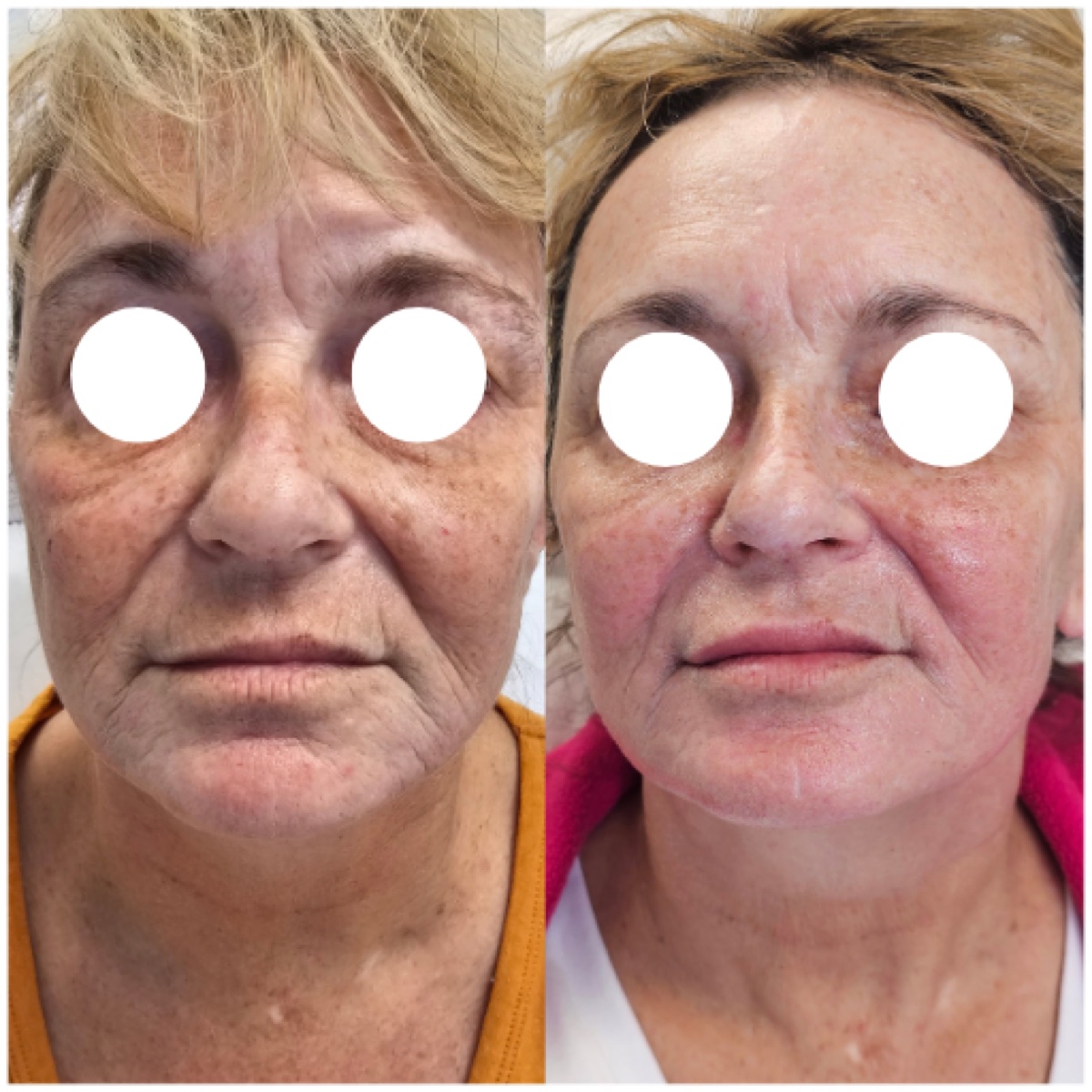 HIFU treatment before and after at Simcoe Cosmetic Clinic