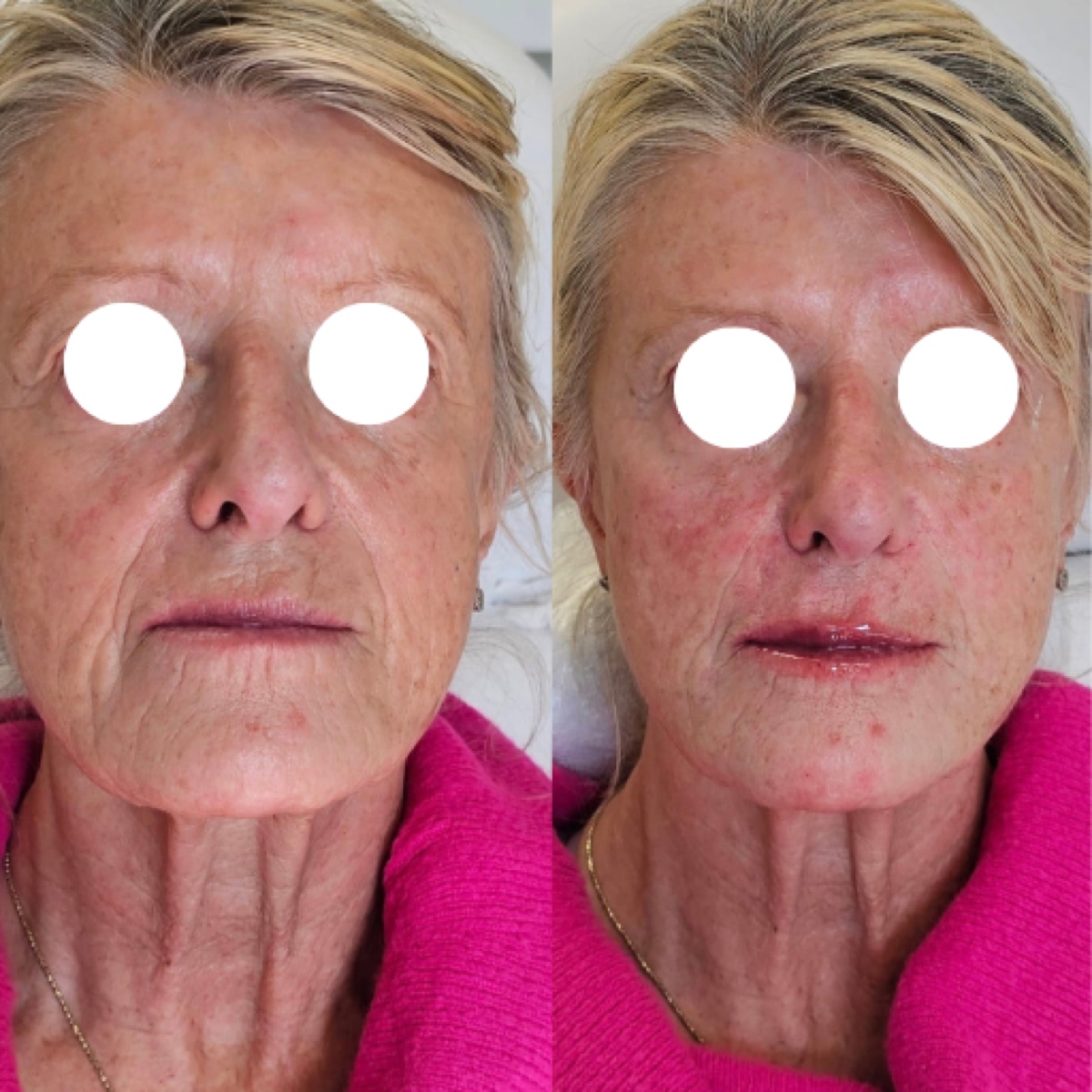 HIFU skin tightening before and after at Simcoe Cosmetic Clinic