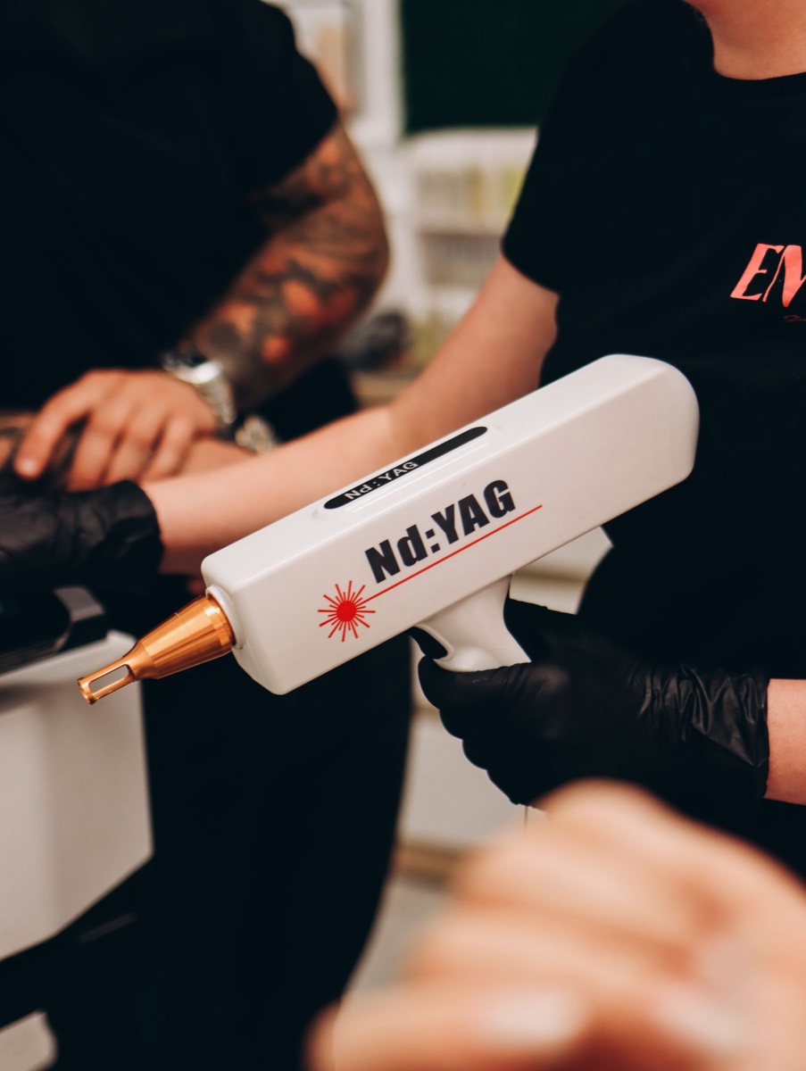 Laser Tattoo Removal