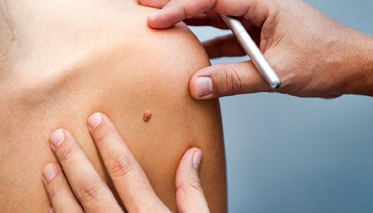 Skin Tag and Wart Removal